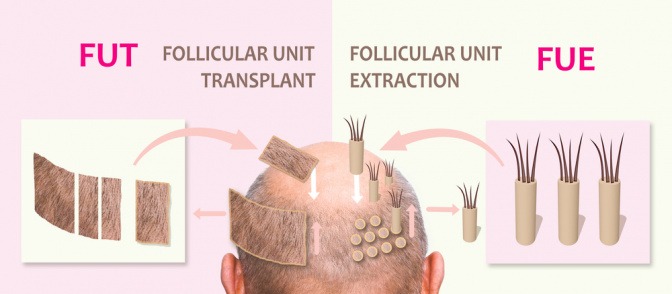 Die Methoden der Haartransplantation FUT und FUE grafisch erklärt