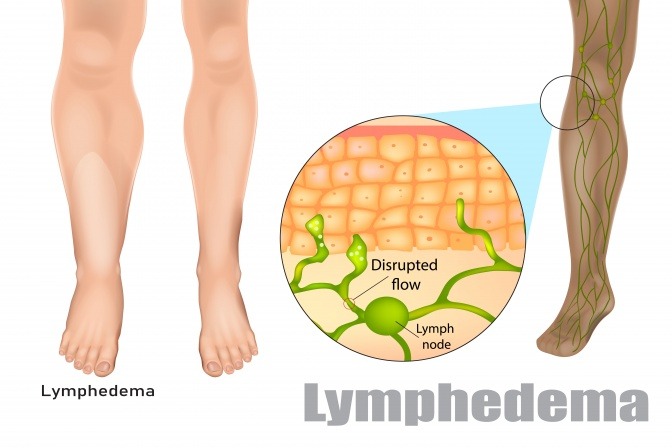 Grafik zeigt Lymphödem