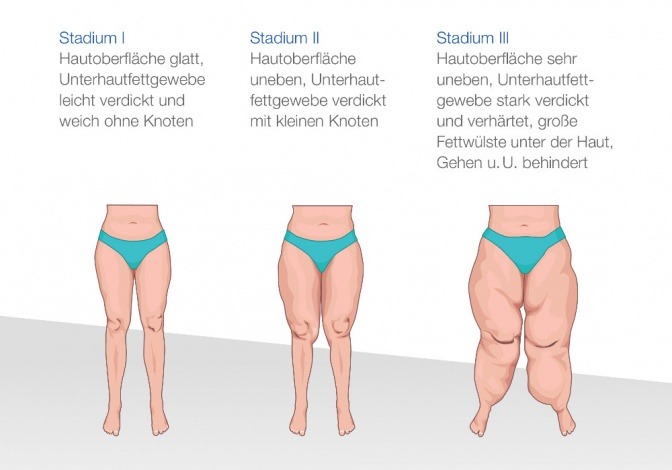 Die Stadien eines Lipödems sind zu sehen