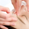 Frau erhält Akupunktur gegen Migräne auf der Stirn